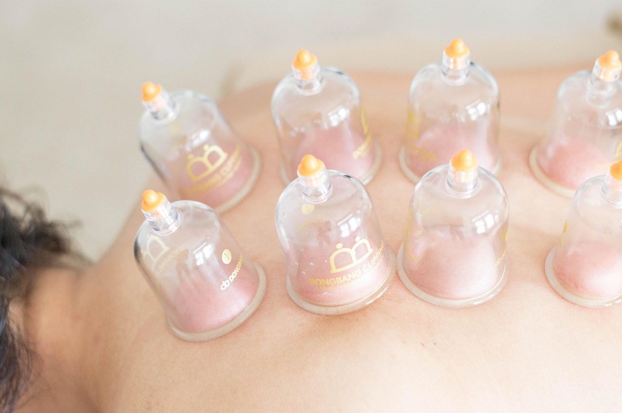 Is Cupping Therapy Effective for Chronic Pelvic Pain?